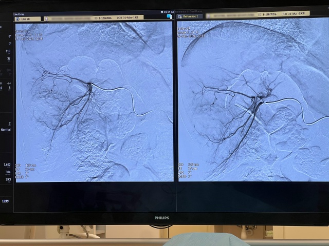 В областном онкоцентре внедрили новый метод лечения опухолей печени В областном онкоцентре внедрили новый метод лечения опухолей печени