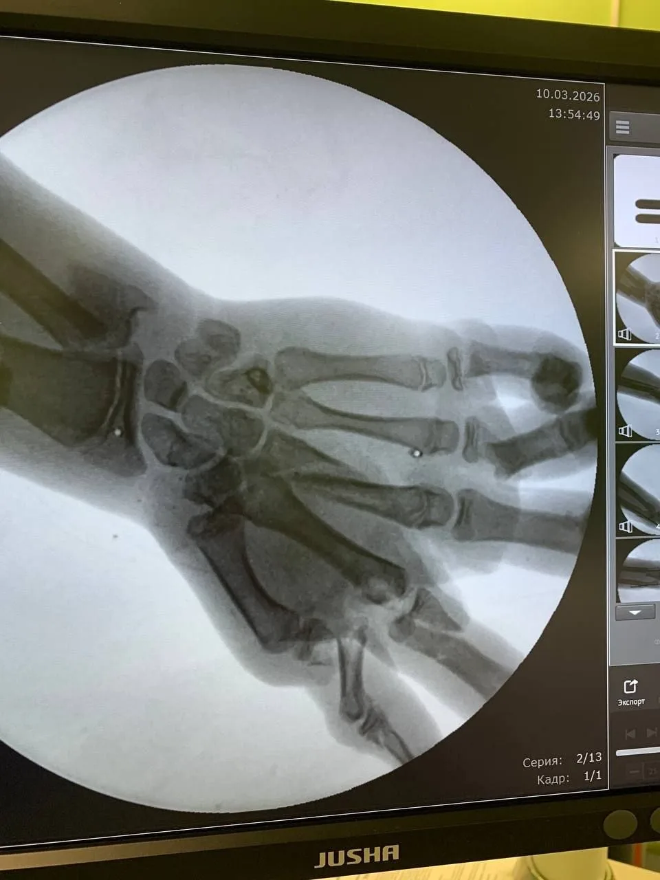 В Калининграде врачи Детской областной больницы спасли кисть подростка после взрыва снаряда В Калининграде врачи Детской областной больницы спасли кисть подростка после взрыва снаряда